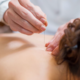 Treating Anxiety and Depression with Acupuncture