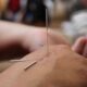 The 3 Important Steps To Set Up An Acupuncture Studio