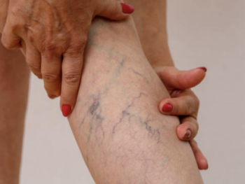 Spider Veins Demystified: Causes, Risk Factors, and Treatment