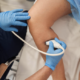 Cosmetic Treatments for Varicose Veins: Say Goodbye to Unwanted Veins
