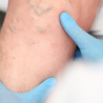 Healthy Veins at Work: Protecting Circulation and Preventing Vein Issues in Desk Jobs