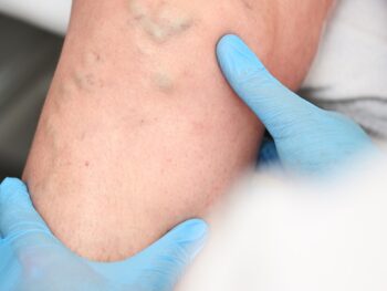 Healthy Veins at Work: Protecting Circulation and Preventing Vein Issues in Desk Jobs