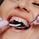 What Are Implant-Supported Dentures and How Do They Work?
