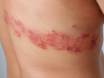 Understanding Shingles: Early Symptoms and When to See a Doctor