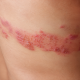 Understanding Shingles: Early Symptoms and When to See a Doctor
